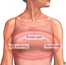 Fibrocystic Breasts