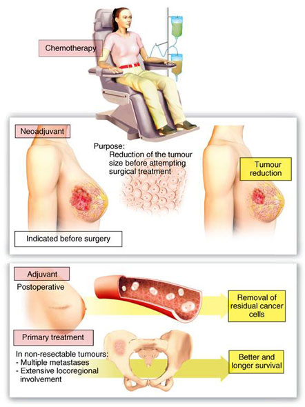 Breast Treatments